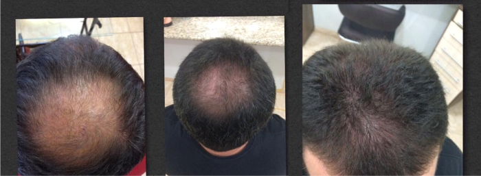 Eduardo Motta é terapeuta capilar, especialista no tratamento de calvície, alopecia areata, alopecia androgenética e outros tipos de alopecia. Seu trabalho com o Urbano Spa, da Grandha, é destaque em Ribeirão Preto.