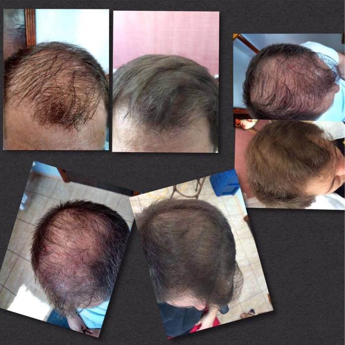 Eduardo Motta é terapeuta capilar, especialista no tratamento de calvície, alopecia areata, alopecia androgenética e outros tipos de alopecia. Seu trabalho com o Urbano Spa, da Grandha, é destaque em Ribeirão Preto.