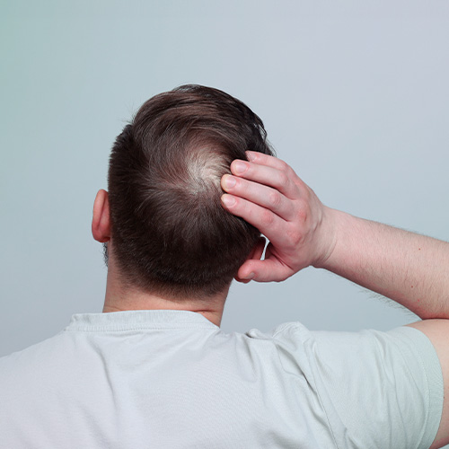 Homem visto de costas com a mão na cabeça, mostrando área de calvície no topo do couro cabeludo.
