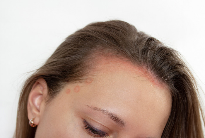 Mulher com irritação avermelhada e descamação no couro cabeludo próximo à testa, indicando sintomas de dermatite seborreica.
