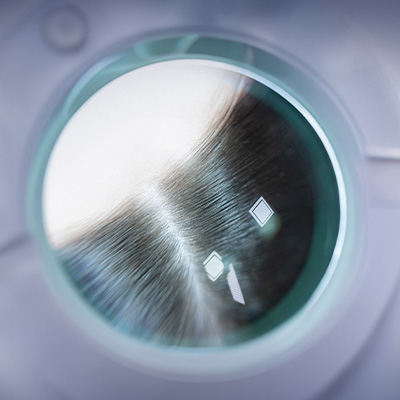 Close do couro cabeludo e fios de cabelo observados por equipamento de análise capilar circular.